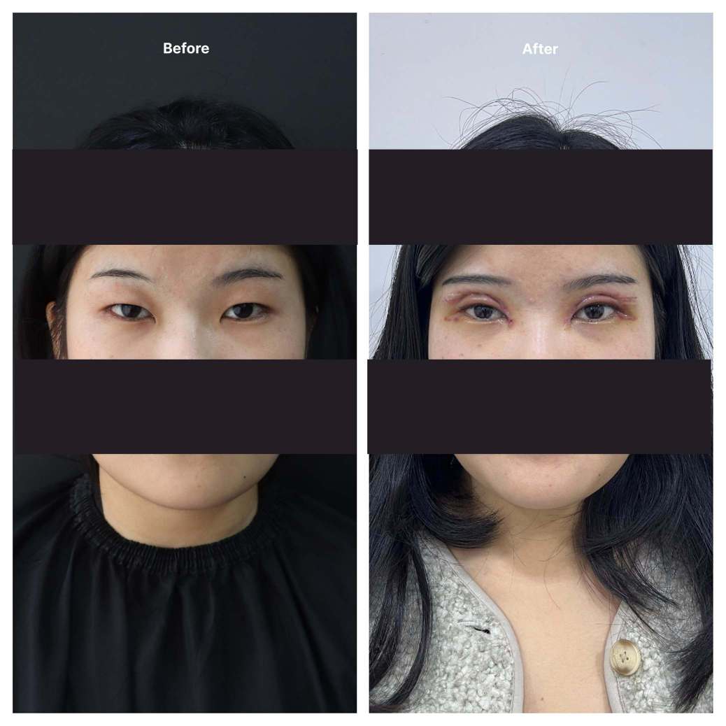 Eyelid Surgery KOQ10